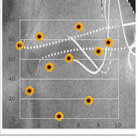 Splenic flexure syndrome