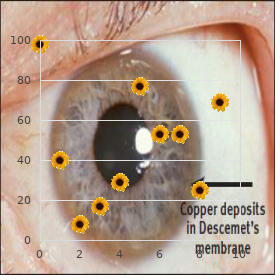 Acutane embryopathy