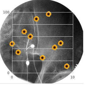 Symphalangism distal