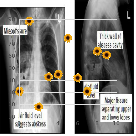 Trichorhinophalangeal syndrome type II