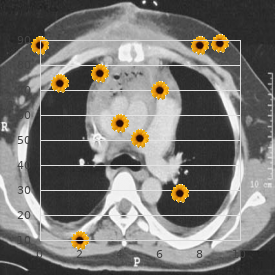 Scleromyxedema