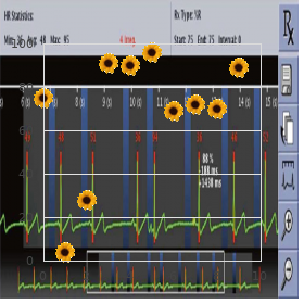 Inborn urea cycle disorder