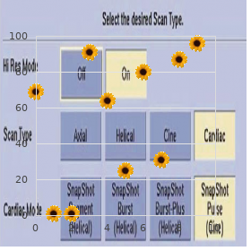 Apolipoprotein C-II deficiency