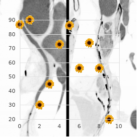 Distal primary acidosis, familial