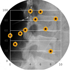 Hypertropic neuropathy of Dejerine-Sottas