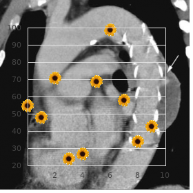 Trichorhinophalangeal syndrome type II