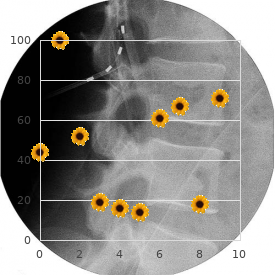 Osteodysplastic dwarfism Corsello type