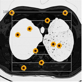 Trisomy 2 mosaicism